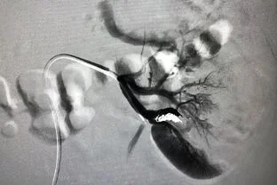 Peripheral Vascular Embolisation